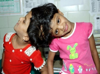 Veena, Vani continue to be looked after by hospital  
