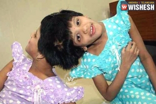 Niloufer Hospital asks Govt to Decide on Conjoined Twins