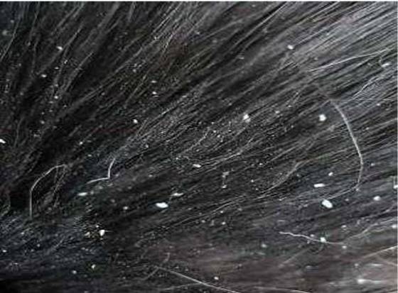 Dandruff... a skin disease??? Dandruff... a skin disease???