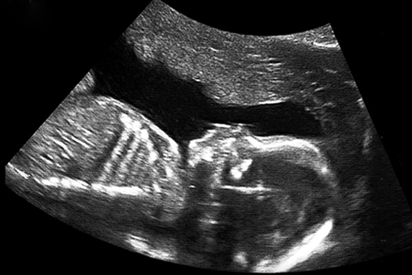 prenatal testing