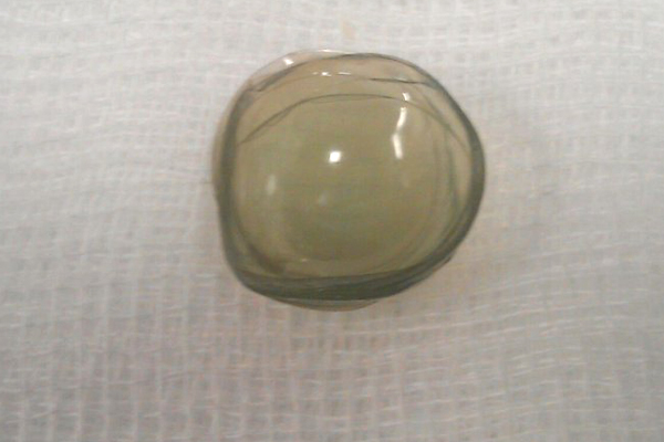 Contact Lenses From Woman Eye