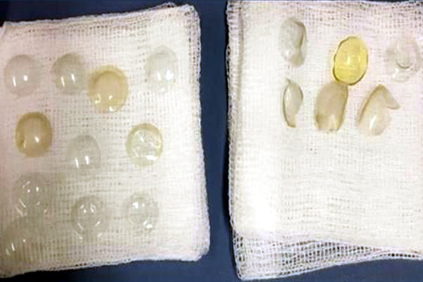 Contact Lenses From Woman Eye