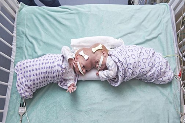Conjoined Twins Erin and Abby Photos