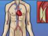 heart attack, bypass, revolutionary heart surgery with 10 grafts, T revolution