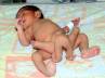 Pakistan, Pakistan, baby with 6 legs, Cosmetic surgeries