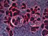 drug resistant gonorrhoea, drug resistant gonorrhoea, std more dangerous than aids, Dangerous than aids