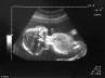 female fetus, illegal abortion, police arrest doctor couple for performing illegal abortions, Male fetus