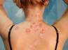 , viruses can cause a psoriasis flare, causes for psoriasis, Immune system