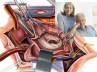 mitral valve surgery, decline in mortality rate., better prognosis for cardiac patients who underwent mitral valve surgery, Mortality rate