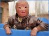 fire accident, Boy in China with burnt face, boy in china with burnt face, Conservative