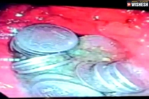 63 Coins Recovered From A Man&#039;s Stomach In Jodhpur