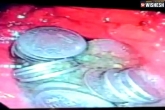 63 coins man stomach surgery, 63 coins man stomach operation, 63 coins recovered from a man s stomach in jodhpur, Man s stomach