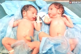 Hyderabad Woman, Hyderabad Woman latest, coronavirus positive woman delivers healthy twins in hyderabad, Us woman