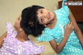 government, Veena-Vani, niloufer hospital asks govt to decide on conjoined twins, Twins