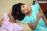 future, conjoined twins, niloufer hospital asks govt to decide on conjoined twins, Conjoined twins