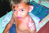 ablaze, FIR, minor boy sets ablaze 3 year old kid for not giving way, Minor boy