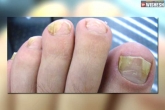 Nail fungal infections tips, Nail fungal infections symptoms, all about nail fungus and why nails turn yellow, Infection