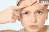tips, tips, 5 natural remedies to get rid of pimples, Remedies
