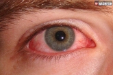 Pink eyes news, Coronavirus, pink eyes the primary symptom of coronavirus, Pink eyes for coronavirus