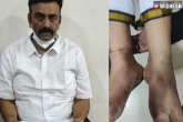 Raghu Rama Krishnam Raju cases, Raghu Rama Krishnam Raju latest news, raghu rama krishnam raju s legs fractured says medical report, Medical