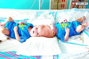 Rare Conjoined Twin Boys Undergo Surgery, Seperated After 27 Hrs