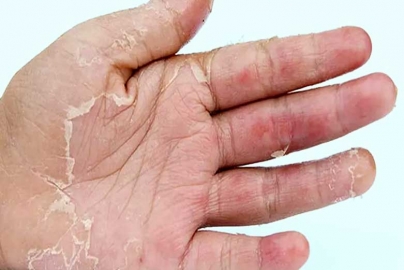 Five causes of Skin Peeling on Hands