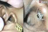 Bengaluru Woman Spider, ear Spider, bengaluru woman complains of headache spotted spider in her ear, Spider