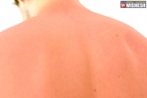 Sunburn symptoms, Sunburn summer, tips and treatment for sunburn, Beauty