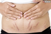 how to reduce stretch marks, how to lighten stretch marks, tips to lighten stretch marks, Stretch marks