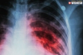Tuberculosis articles, Tuberculosis breaking news, all about tuberculosis and its treatment, Cure