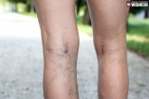 Varicose Veins new updates, Varicose Veins pictures, symptoms of varicose veins, Atm