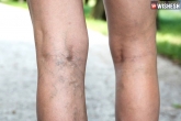 Varicose veins news, Varicose veins, six myths about varicose veins, Health problem