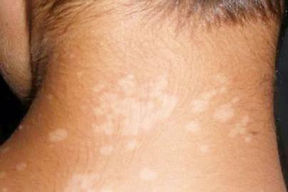 What are the indications White Patches On Skin?