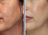 Lactic acid., Skin care tips, don t let pigmentation make you hyper, Mackup tips