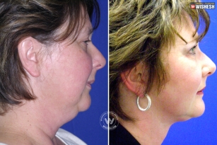 Is your Neck fat? Here’s the solution