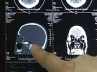 Nakul Bhargava, Delhi Doctors, delhi doctors removed bullet from boy s skull after 27 hours, Doctors remove 14 cm