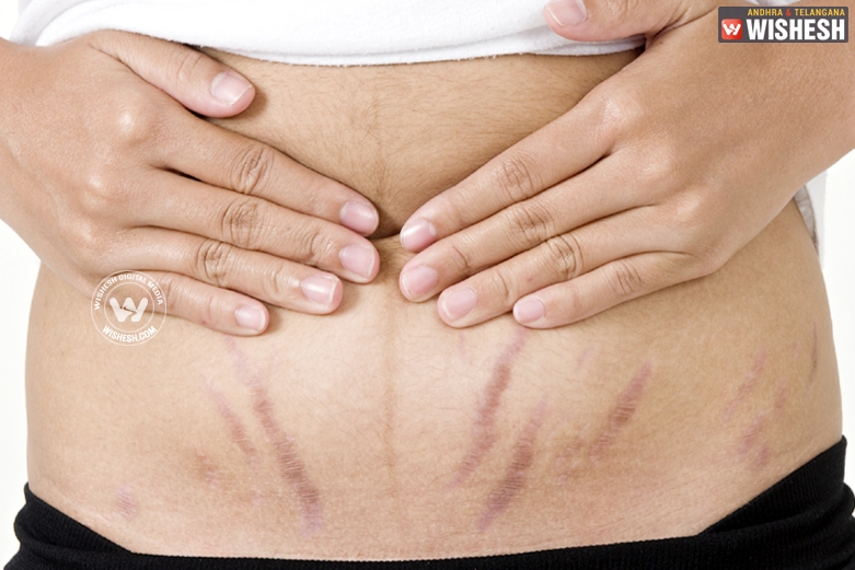 Tips to lighten stretch marks
