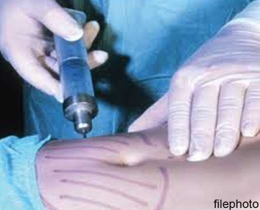 Doctors on trail, lipo patient succumbs post-surgery
