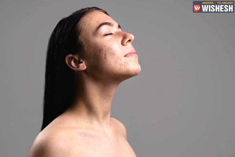 Here are some Tips if you have Acne-Prone Skin