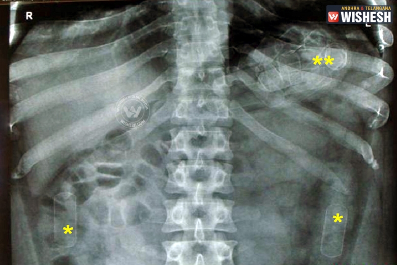 Woman claims pregnancy, hiding drugs in stomach