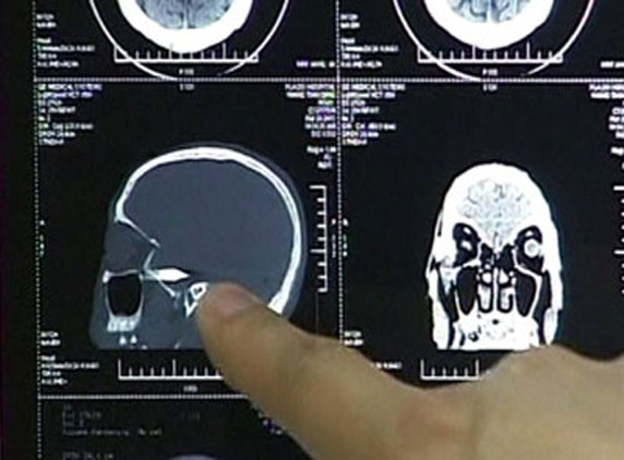 Delhi Doctors removed bullet from boy's skull after 27 Hours